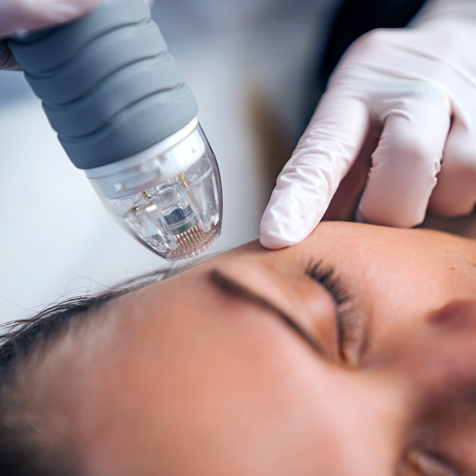 An image of a person having a microneedle RF lifting procedure.