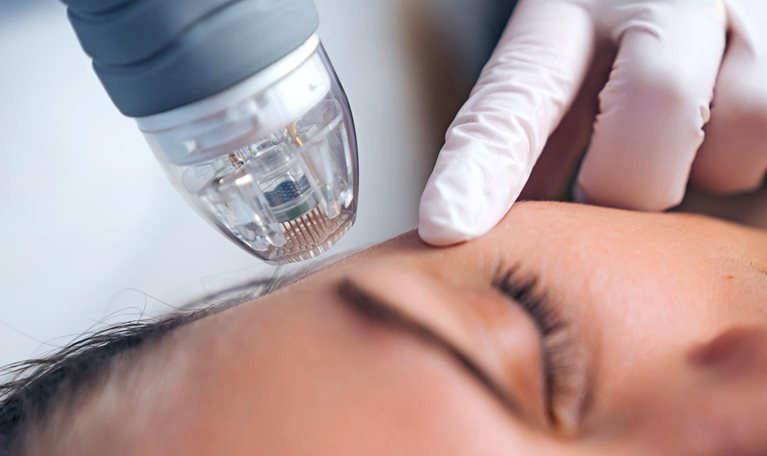 An image of a person having a microneedle RF lifting procedure.